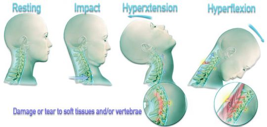 Should I Get an MRI if I have Whiplash? » 1-800-Injured