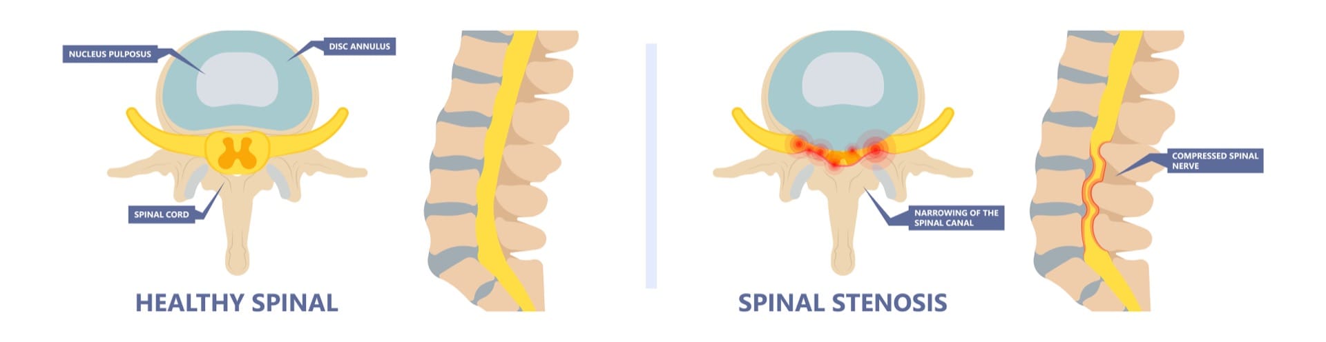 Spinal Stenosis Surgery Florida